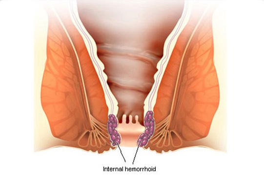 Pierderea în greutate a hemoroizilor interni - Hemoroid - Wikipedia