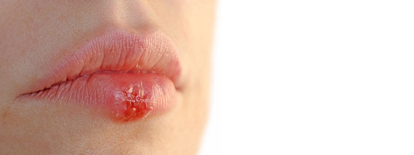 Herpesul oral (HSV-1)